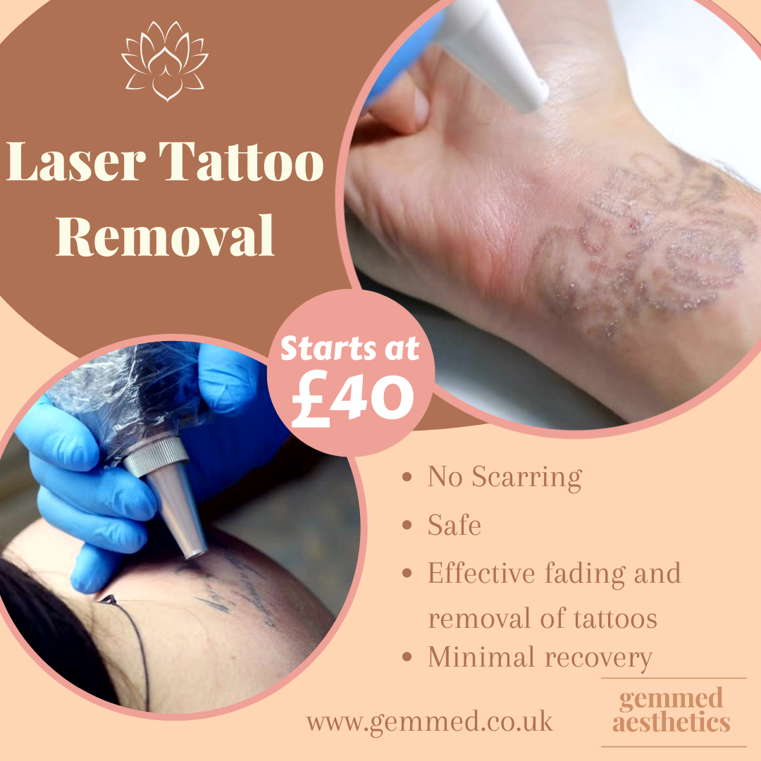 Tattoo Removal Services Near Me